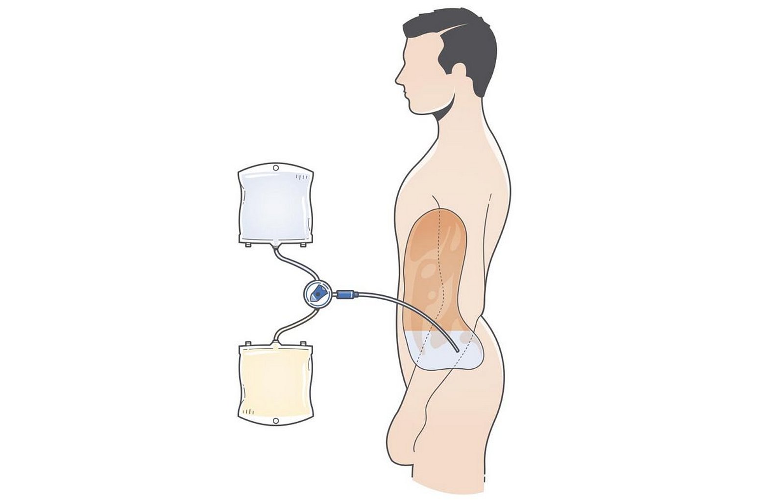 Illustration av behandling med peritonealdialys